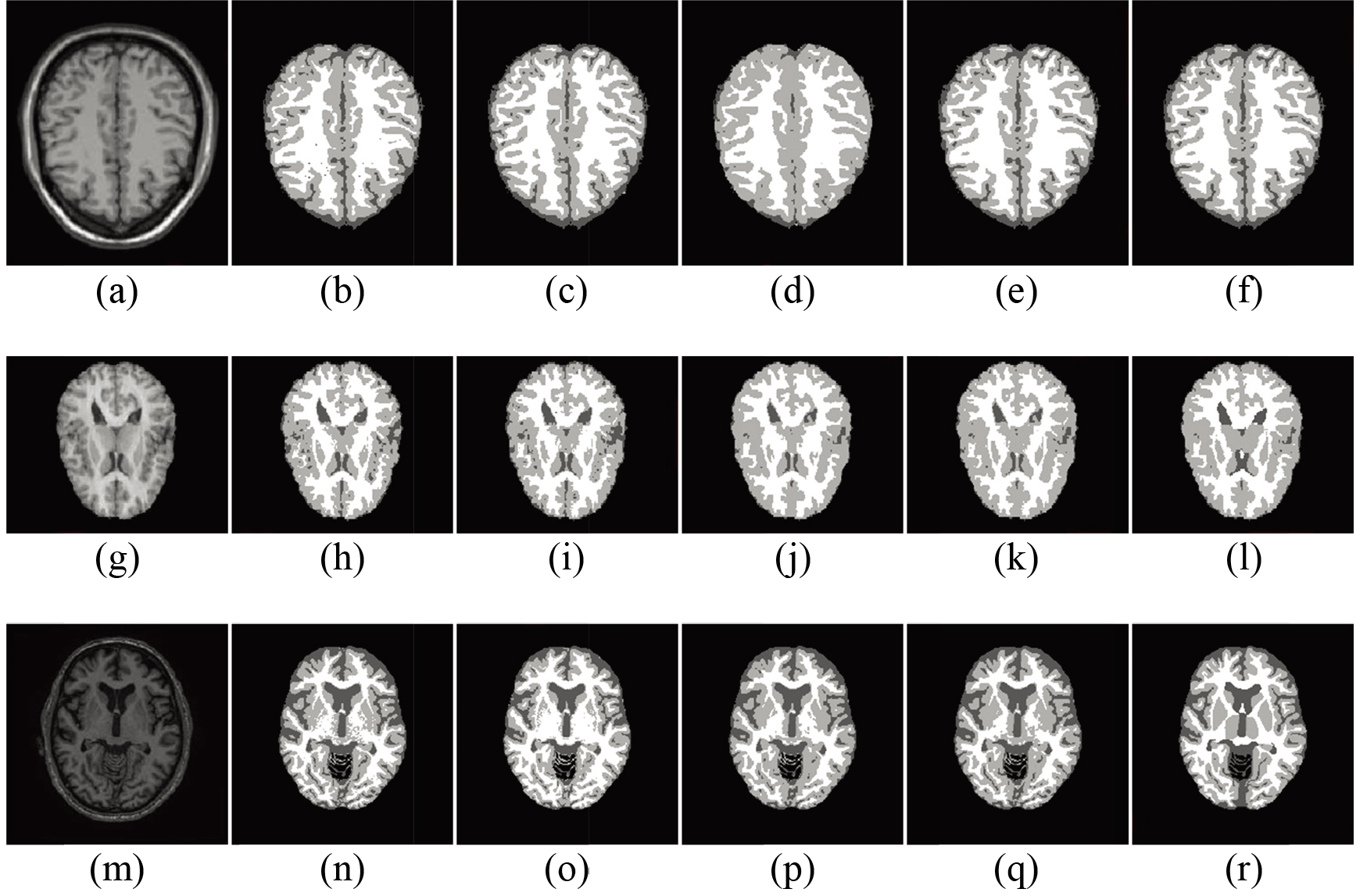 Example classification results: (from left to right) original MR slice, result of Method A, B, C, the proposed method, and the ground truth. The three rows indicate example BrainWeb (3 mm thickness, 1% imaging noise and 20% bias field level), IBSR, and MRBrainS13 slice, respectively. CSF, GM and WM are displayed by dark gray, light gray and white color.