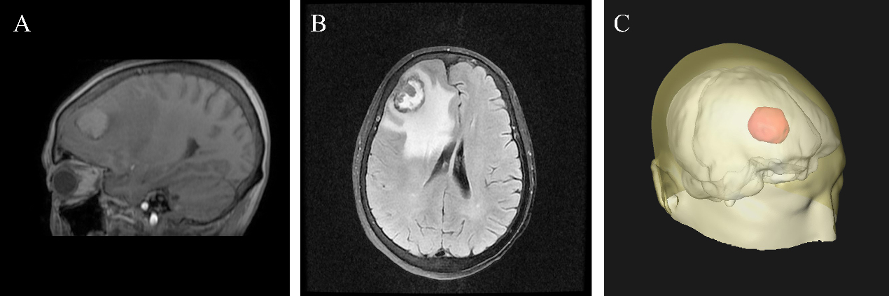 Imaging characteristics of metastatic brain lesions. (A) On sagittal GRE T1 map, the tumor is located in the medullary junction of the right frontal lobe with irregular contour. The sign of the tumor is slightly lower in the periphery and slightly higher in the middle. (B) T2 flair of transverse lesion showed that the tumor presented mixed signals with low signal in the peripheral area and slightly high signal in the middle area. The edge of the tumor is rough with a large edema surrounding it and the midline of the prefrontal structure is left-skewed. (C) The three-dimensional fluoroscopy clearly shows the overall structure of the brain and the location of the tumor, providing an intuitive and comprehensive imaging basis for preoperative positioning.