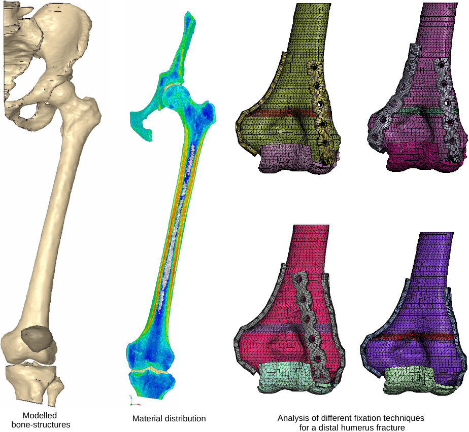 Modelled bone and implant structures.