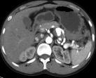 CT enhancement shows an outward protruding cystic shadow of the splenic artery, and it was diagnosed as splenic arterypseudoaneurysm. The patient was admitted to the hospital with abdominal pain and black stool as the chief complaint.
