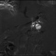 Intraoperative angiography showed splenic artery protruding sac shadow during TAE, confirming the diagnosis of splenic arterypseudoaneurysm.