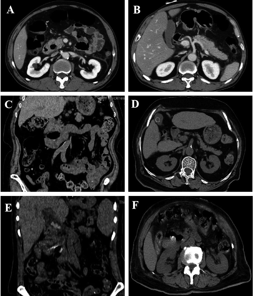 A–B: male, 49 years old, enhanced scan portal venous phase, type I, medium diverticulum, pancreatic swelling, a small amount of exudative changes around the pancreas, thickening of the left prerenal fascia, considering JPDD with edematous pancreatitis, MSCT image grade 1. C–D: male, 72 years old, abdominal plain scan MPR coronal and axial, type I, large diverticulum, annular high-density lesions in the gallbladder, considering JPDD combined with gallstone MSCT image grade 2; E–F: male, 63 years old, MPR axial and coronal plain abdominal scan, type III, large diverticulum, multiple nodular high-density shadows in the common bile duct, thickening and blurring of the bile duct wall, bile duct dilatation above the obstruction level, considering JPDD with multiple common bile duct stones and cholangitis, MSCT imaging grade 2.