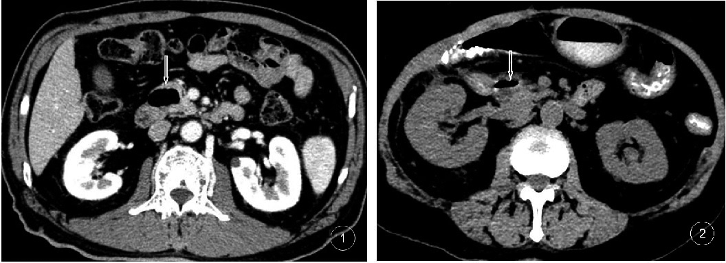 1 Male, 68 years old, JPDD containing gas; 2 Female, 71 years old, JPDD containing a gas-liquid level and a small amount of high-density contrast medium, being compressed adjacent to the lower end of the common bile duct.