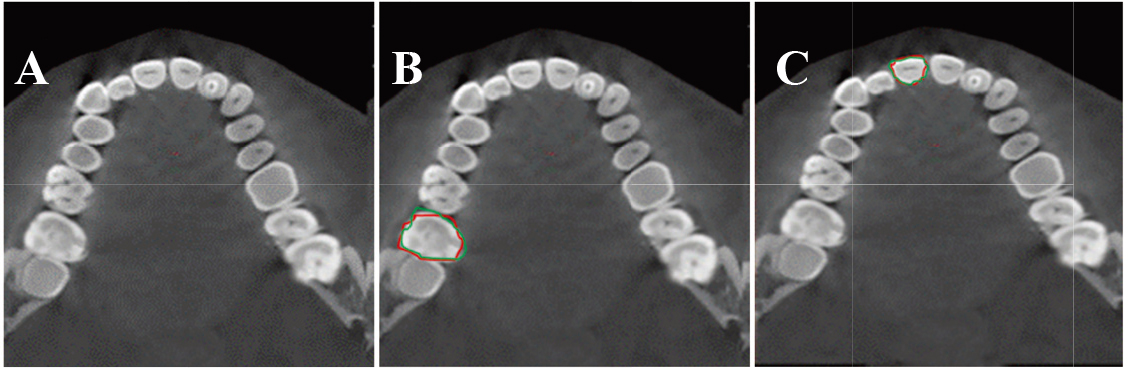 CBCT cross-sectional tooth segmentation results. A: original CBCT image; B: molar segmentation result; C: incisor segmentation result.
