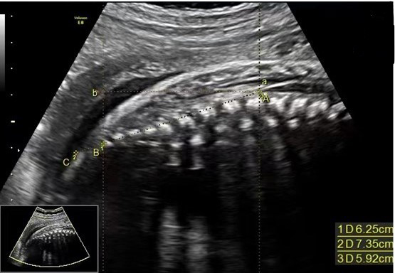 Measurement of D1, D2 and HD ultrasound schematic diagram. The distance between A and B is D1. The distance between A and C is D2. The distance between a and b is HD. Point A (also marked as “a”) stands for the end of the fetal conus medullaris, point B stands for the caudal end of the ossification center of the terminal vertebral body, point C is the intersection of the D1 extension and the caudal skin, point b is the intersection of the horizontal line passing through point A (or a) and the vertical line passing through point B.
