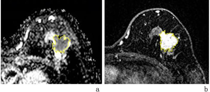 Segmentation results of a single breast mass on the left side of a breast cancer patient in ADC and DCE images. Note: a: ADC image; b: DCE image. The yellow-lined area represents the ROI.