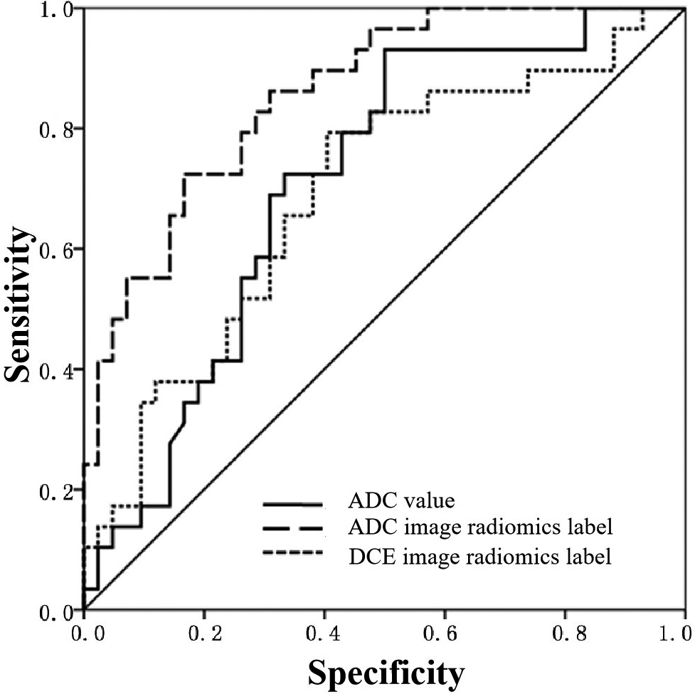 ROC curve of ADC value and radiomics signature model for identifying IDC of different grades in breast cancer patients.