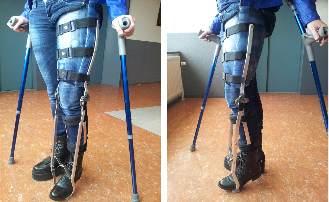 Example of the custom-made orthosis worn by a patient.