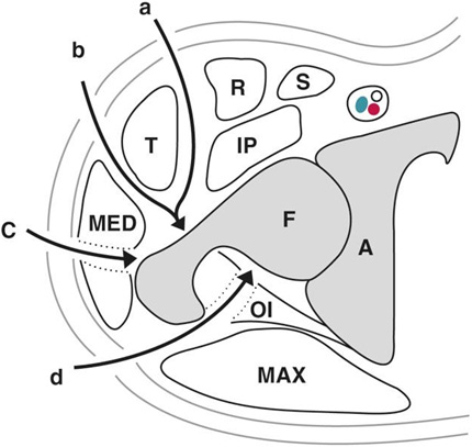 Operative approaches for hip arthroplasty. Direct anterior/anterolateral approach (a,b), lateral approach (c), posterolateral approach (d).