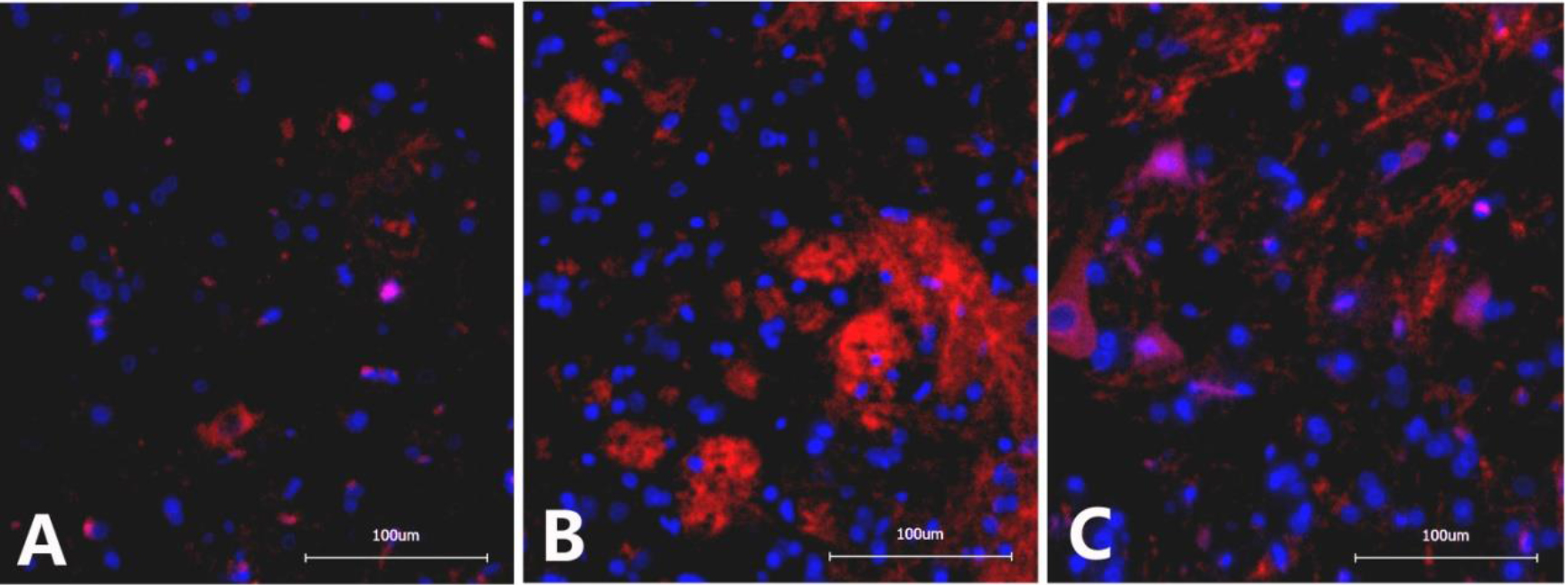 Immunofluorescence images of CR3/CD11B in the dorsal horn of the L6-S1 spinal cord in different groups of rats. A. Sham operation group: Scattered expression of CR3/CD11B with small, inconspicuous cell bodies and lightly stained chromosomes; B. NBP model group: Significantly increased CR3/CD11B expression with apparently enlarged cell bodies and darkly stained chromosomes; C. NBP+intrathecal BNP injection group: GFAP expression was reduced compared with the NBP model group. Magnification at 200x. 