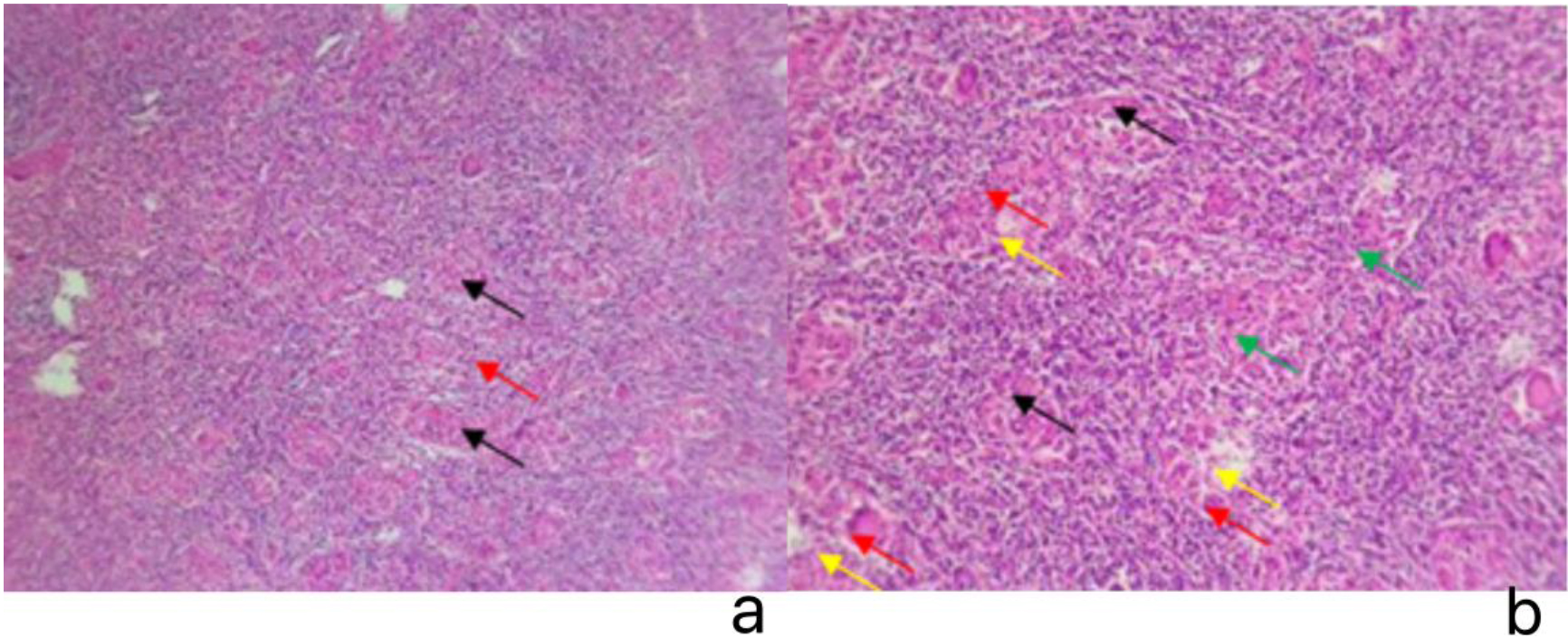 Tumor pathology images under microscope. (a) HE × 40, low magnification. Under the microscope, tumor cells are observed arranged in small clusters or cord-like structures (black arrows), with abundant lymphocytes dispersed between them (red arrows). (b) HE × 200, high magnification. Under the microscope, tumor cells appear spindle-shaped or oval (black arrows), arranged around multinucleated giant cells (red arrows) to form granulomatous structures (yellow arrows). In areas lacking multinucleated giant cells, tumor cells are arranged in clusters and interwoven cord-like structures (green arrows).