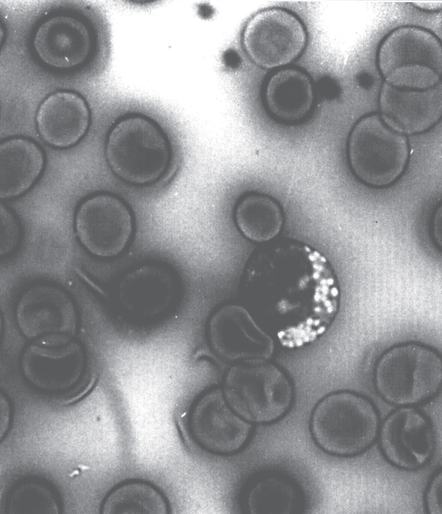 Vacuolated lymphocyte in the peripheral blood of a patient with mannosidosis.