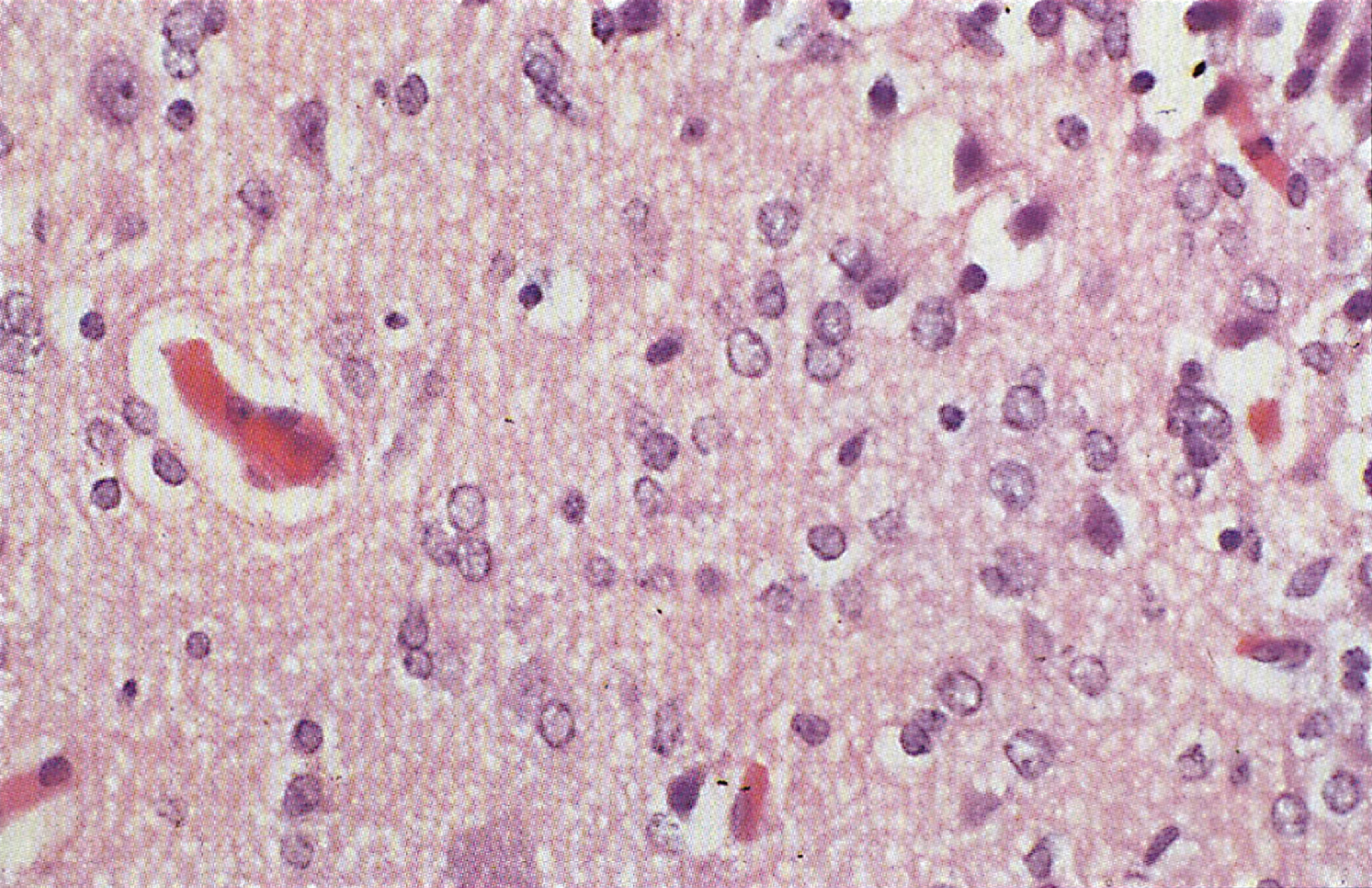 CPS deficiency. Microscopic section of the cortex of the brain showing Alzheimer type II astrocytes in the white matter. Nuclei are swollen and appear as naked nuclei.