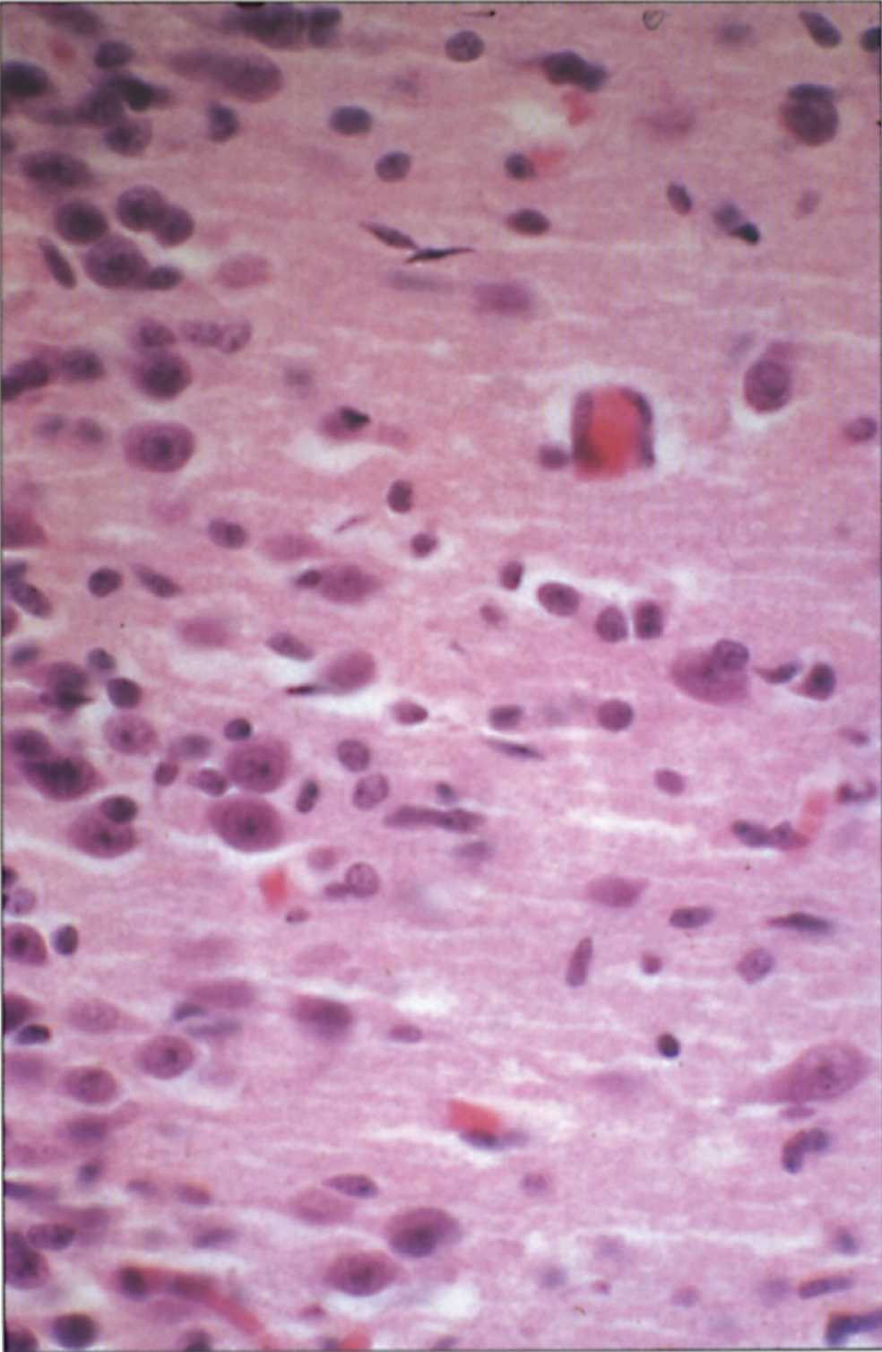 CPS deficiency. Microscopic section of cortex showing clusters of glial cells around neurons— “eggs in a basket” pattern.
