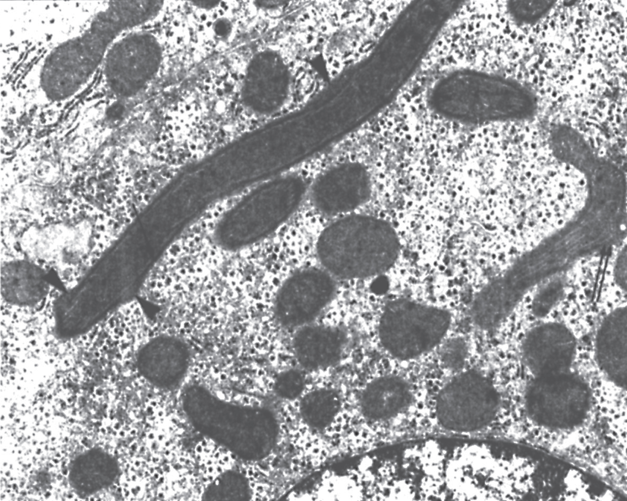 HHH syndrome. Increased number of mitochondria in the perinuclear region of a hepatocyte display altered forms and length. The long forms show tubules running parallel to the longitudinal axis, a thick structure applied to the inner mitochondria memberane (arrow) with sieve-like appearance on a slightly tangential cut (double arrow), and several small bulges protruding from the surface (arrowheads). Note the peripheral arrangement of the tubules on cross-sections. (Courtesy of Dr. M. Daria Haust.)