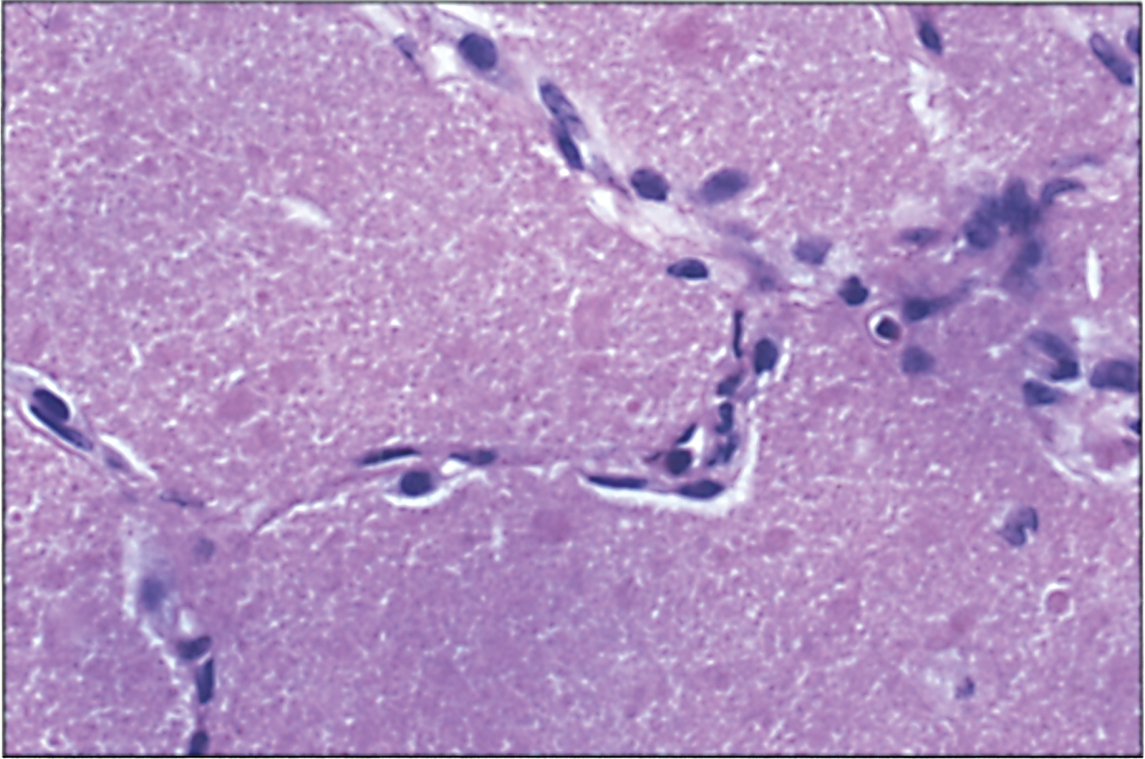 Microscopic section of lung showing alveolar proteinosis as may be seen in lysinuric protein intolerance. The alveoli are filled with proteinaceous material that is periodic acid-Schiff (PAS) positive.