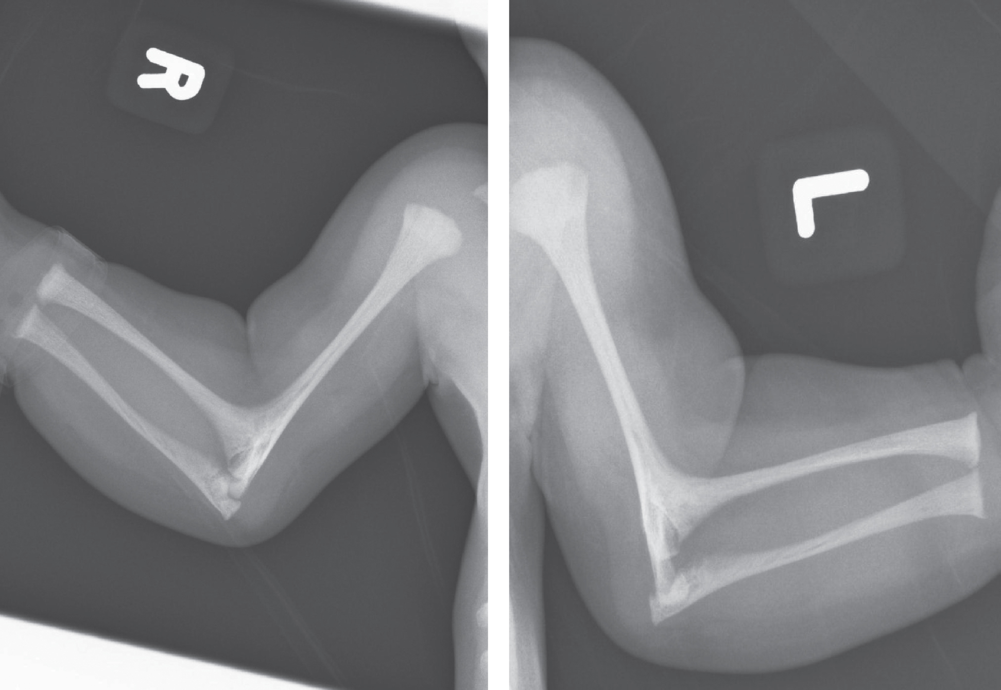Radiographs of right and left upper limbs in the patient from Fig. 11 showing bilateral radiohumeral synostosis. (Courtesy from Malgorzata J.M. Nowaczyk, MD, McMaster University, Hamilton, Canada).