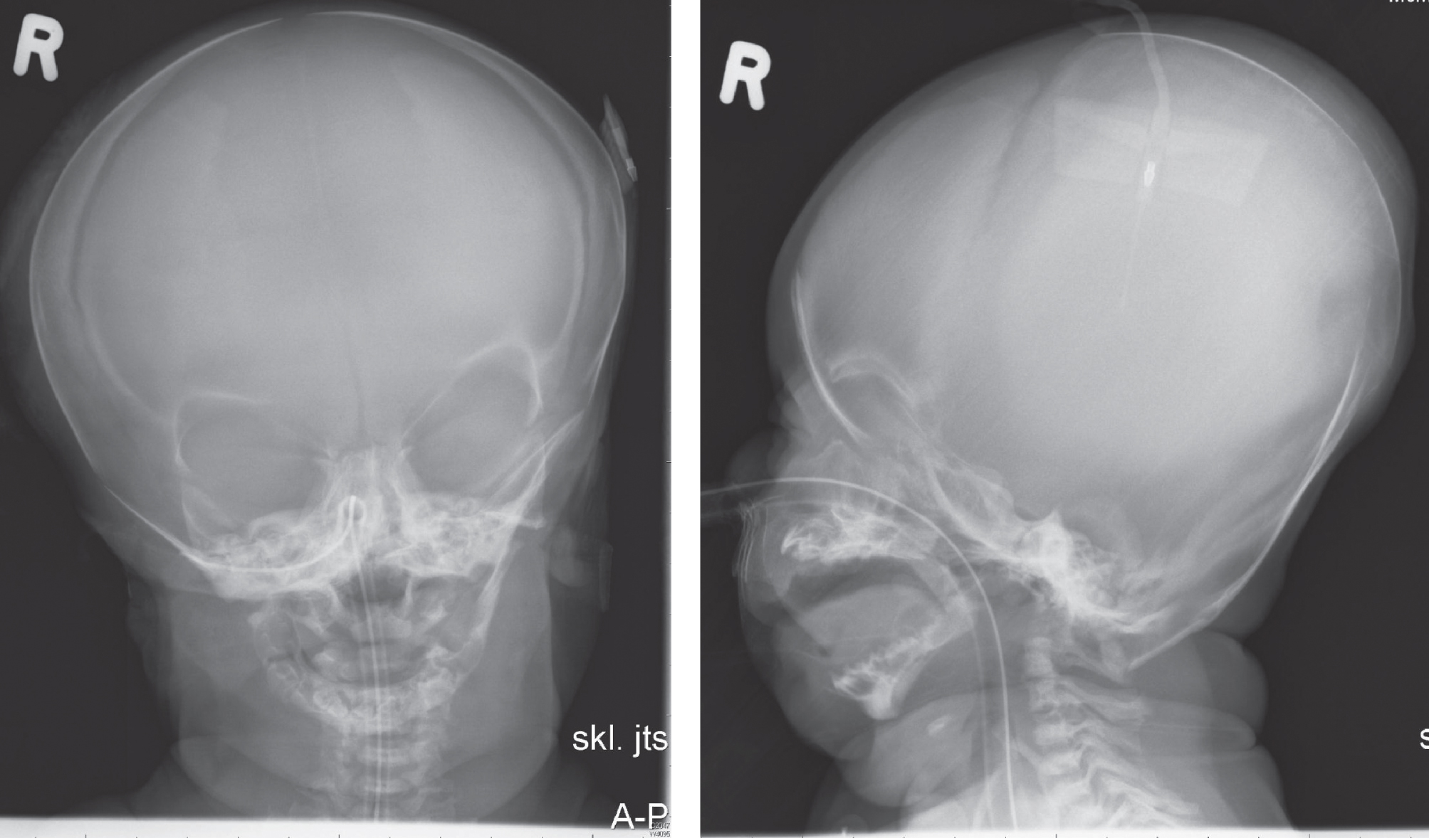Skull radiographs in the patient from Fig. 11 showing synostosis of coronal and lambdoid sutures. (Courtesy from Malgorzata J.M. Nowaczyk, MD, McMaster University, Hamilton, Canada).