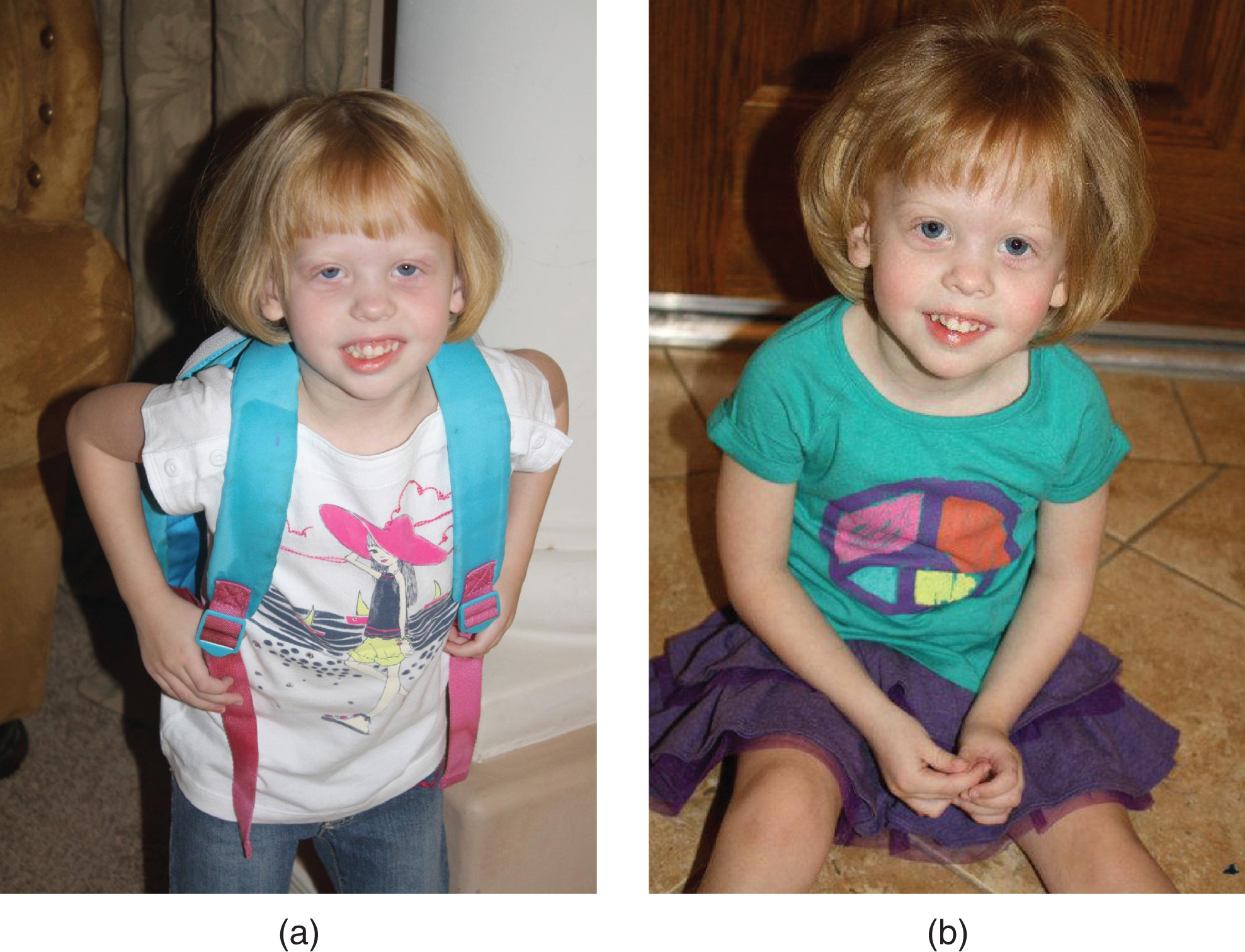 a, b. 2-year-old girl with “mild” RSH/SLO syndrome diagnosed clinically (2/3 toe syndactyly!) at 17 months; confirmed biochemically by Dr. R.I. Kelley (7DHC: 86 mcg/nL, cholesterol: 102 mg/dL. Being followed by Dr. F.D. Porter at the NIH and Dr. R.D. Steiner at OHSU/Portland. The latter has determined 2 different mutations in the DHCR7 gene (R450L and N407K). She was born normally but developed reflux, failure to thrive, sleep disturbance, mild developmental and growth delay. Cholesterol treatment appeared to lead to a deterioration of behavior; Simvastatin treatment (Jira et al., 2000) did not appear to affect development. Now toilet-trained and in 3rd grade (special education).