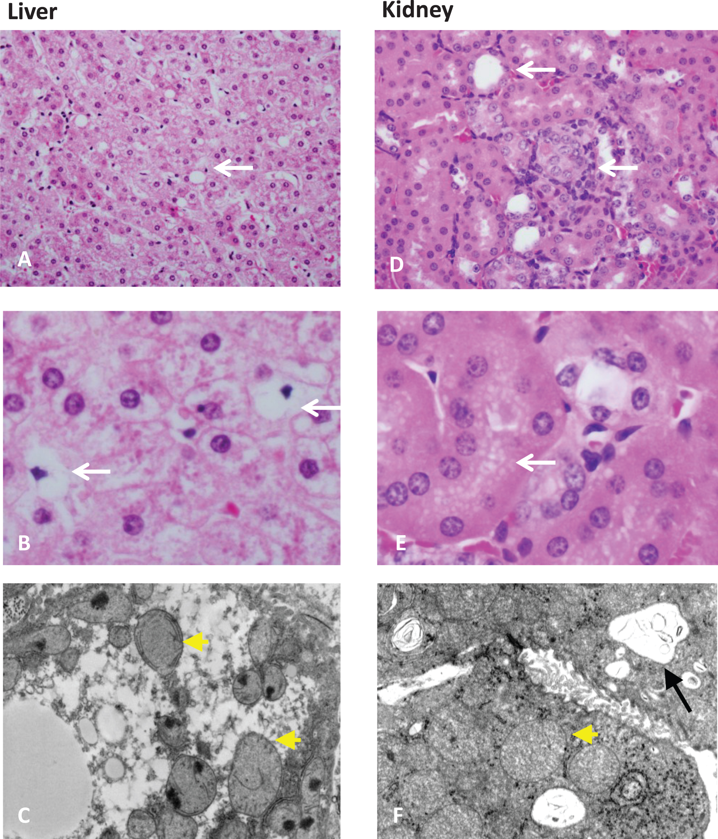 Organ pathology in methylmalonic acidemia. Liver and kidney pathology from patients with mut0 methylmalonic acidemia are presented. Mild steatosis (A), lipid-laden stellate cells (white arrows) (B), with abnormal mitochondrial ultrastructure on transmission electron microscopy (EM) (pale mitochondria with absent or disorganized cristae, yellow arrowheads) are observed in patient livers. Tubulointerstitial nephritis with patchy interstitial chronic inflammation and tubular dilation (A), proximal tubule vacuolization (B) (white arrows), and enlarged mitochondria with disorganized cristae (yellow arrowhead) along with large remnant vacuoles that contained amorphous membranous inclusions (black arrow) on transmission EM are present in patient kidneys. Pathology was obtained from explanted organs after a combined liver and kidney transplantation procedure. Patients were enrolled in the clinical study: NCT00078078.