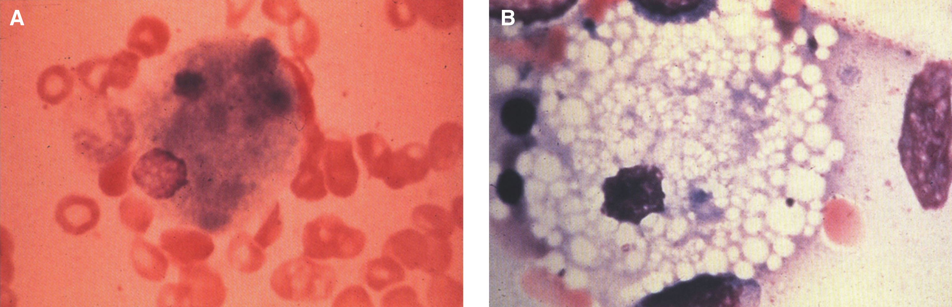 Niemann-Pick disease. (A) A sea-blue histiocyte is present in the marrow. These cells are predominantly seen in types C and F. (B) A histiocyte in the bone marrow has a “soap-bubble” appearance and measures 60 to 80 μm in diameter.