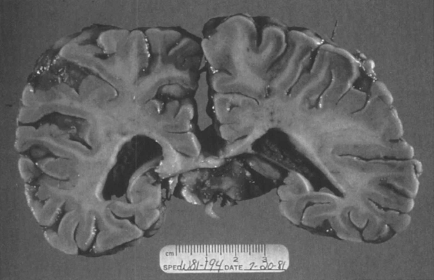 Niemann-Pick disease. A child 2 years of age. The brain is atrophic with enlargement of the ventricles.