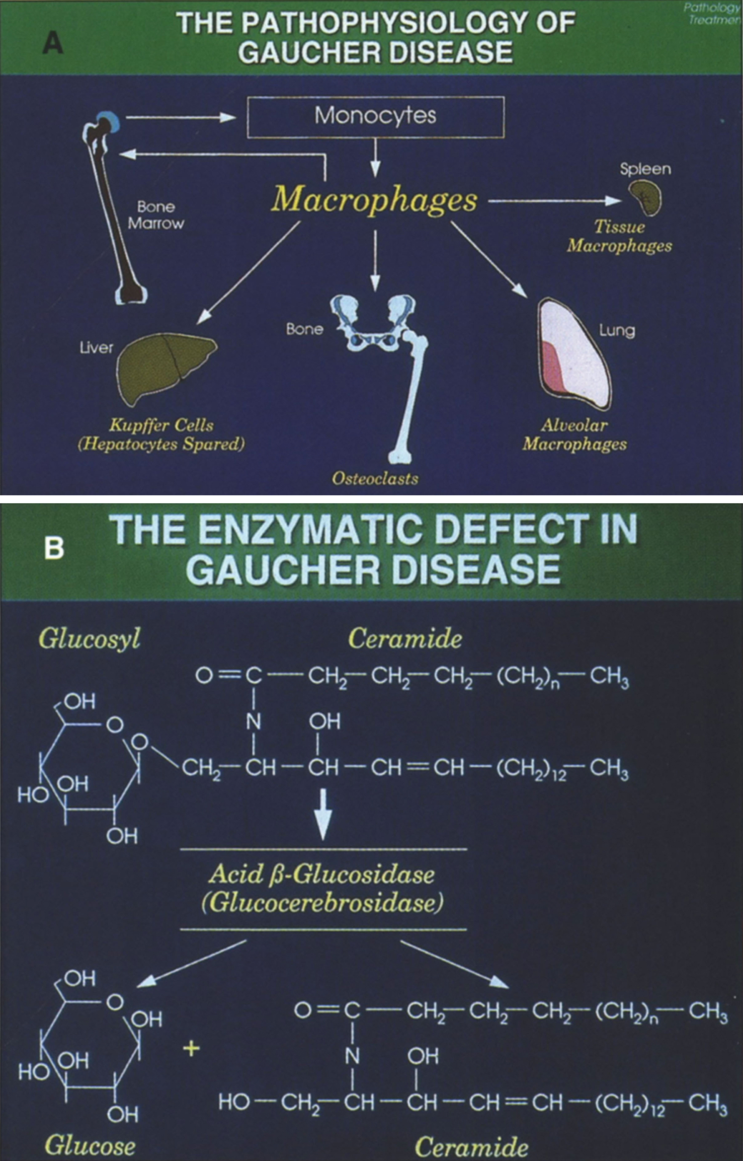 (A) The pathophysiology of Gaucher disease. It should be noted that this macrophage-centric view of the disease has recently been called into question, since it does not explain certain aspects of the disease such as the predisposition to malignancy, osteoporosis or Parkinson disease (108). (B) The enzymatic defect in Gaucher disease. (From Gaucher Disease Diagnosis Evaluation and Treatment, Genzyme Therapeutics, Parsipanny, NJ; with permission.)