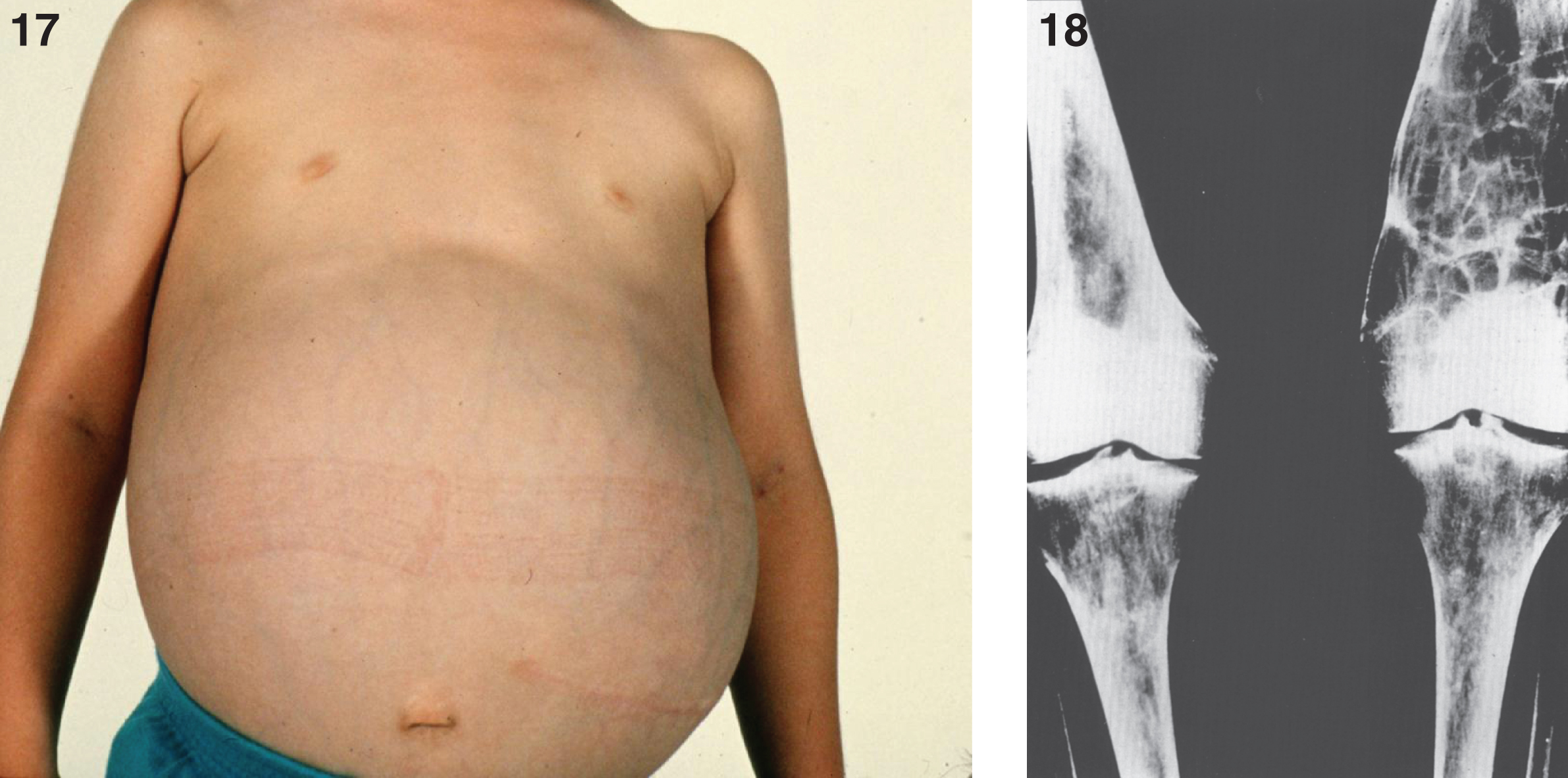 Gaucher disease type I. A child 10 years of age showing marked distension of the abdomen due to massive splenomegaly. The spleen was surgically removed and weighed 10 kg; (18) Gaucher disease. Radiograph of lower extremities showing Erlenmeyer flask deformity of the distal ends of the femur.