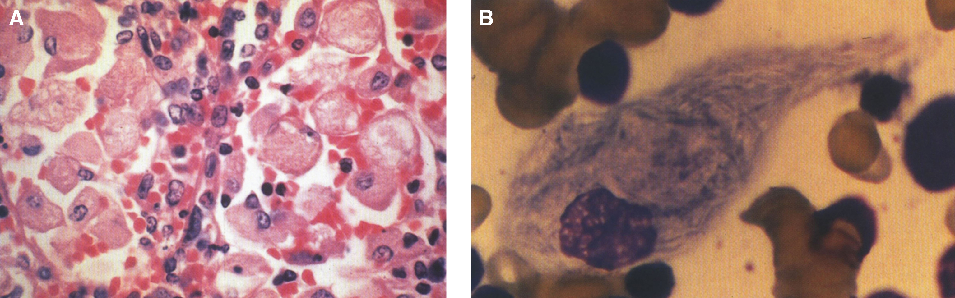 Gaucher disease. (A) Microscopic section of the spleen. The sinusoids are filled with large distended storage cells. (B) The bone marrow contains a large Gaucher cell with cytoplasmic striations with typical “crinkled tissue paper” appearance.