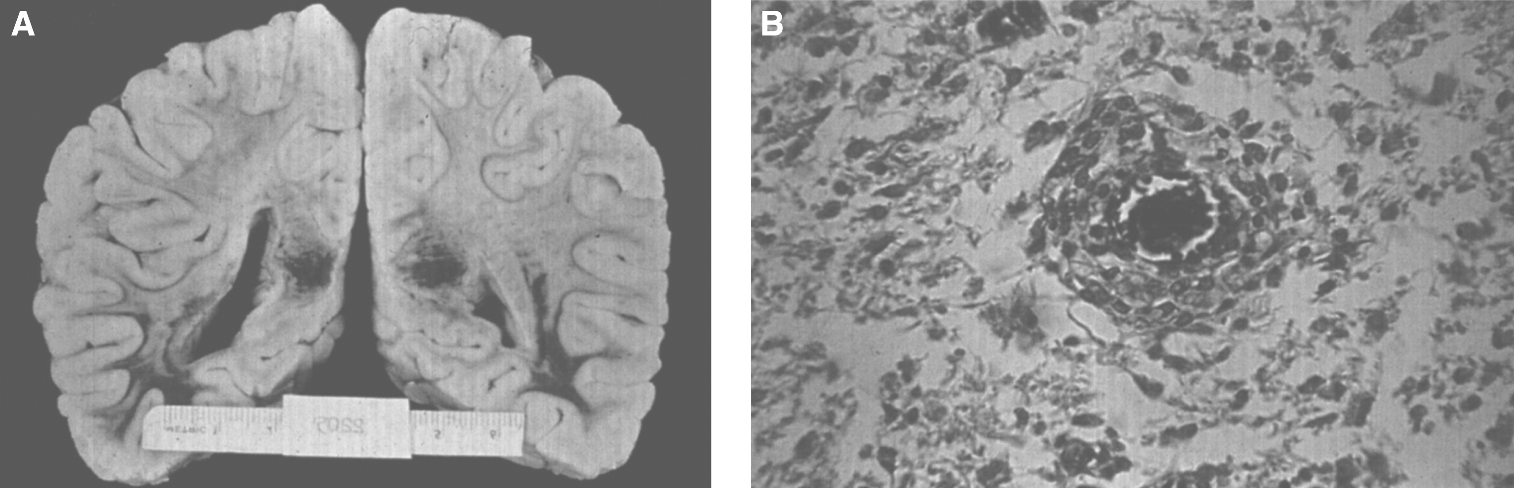 Krabbe disease. (A) Coronal section of the brain stained with oil red O. Only a few myelinated areas stain. The remainder of the white matter does not stain, indicating loss of myelin. (B) Microscopic section of brain with globoid cells in white matter. The brain does not store the substrate, galactosylceramide, but it stimulates infiltration of macrophages which transform to globoid cells. The increased levels of psychosine that occur have cytotoxic effects.
