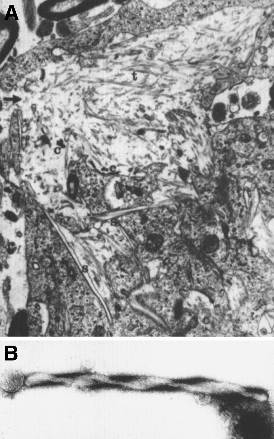Krabbe disease. Electron micrograph of brain. (A) A globoid cell containing tubules with electron-dense deposits. (B) High magnification of the twisted tubule with a counterclockwise spiral.