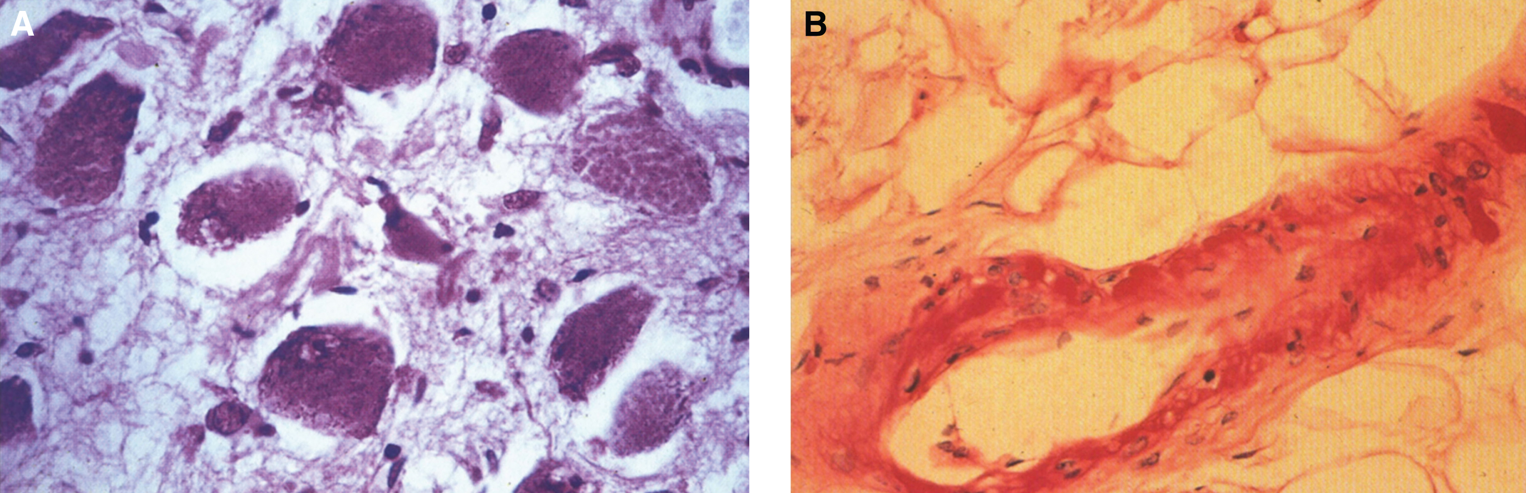Fabry disease. (A) Microscopic section of the myenteric plexus showing large distended ganglion cells that are PAS-positive. (B) Microscopic section of a blood vessel showing thickening of the vessel wall by accumulation of glycosphingolipid (PAS stain).