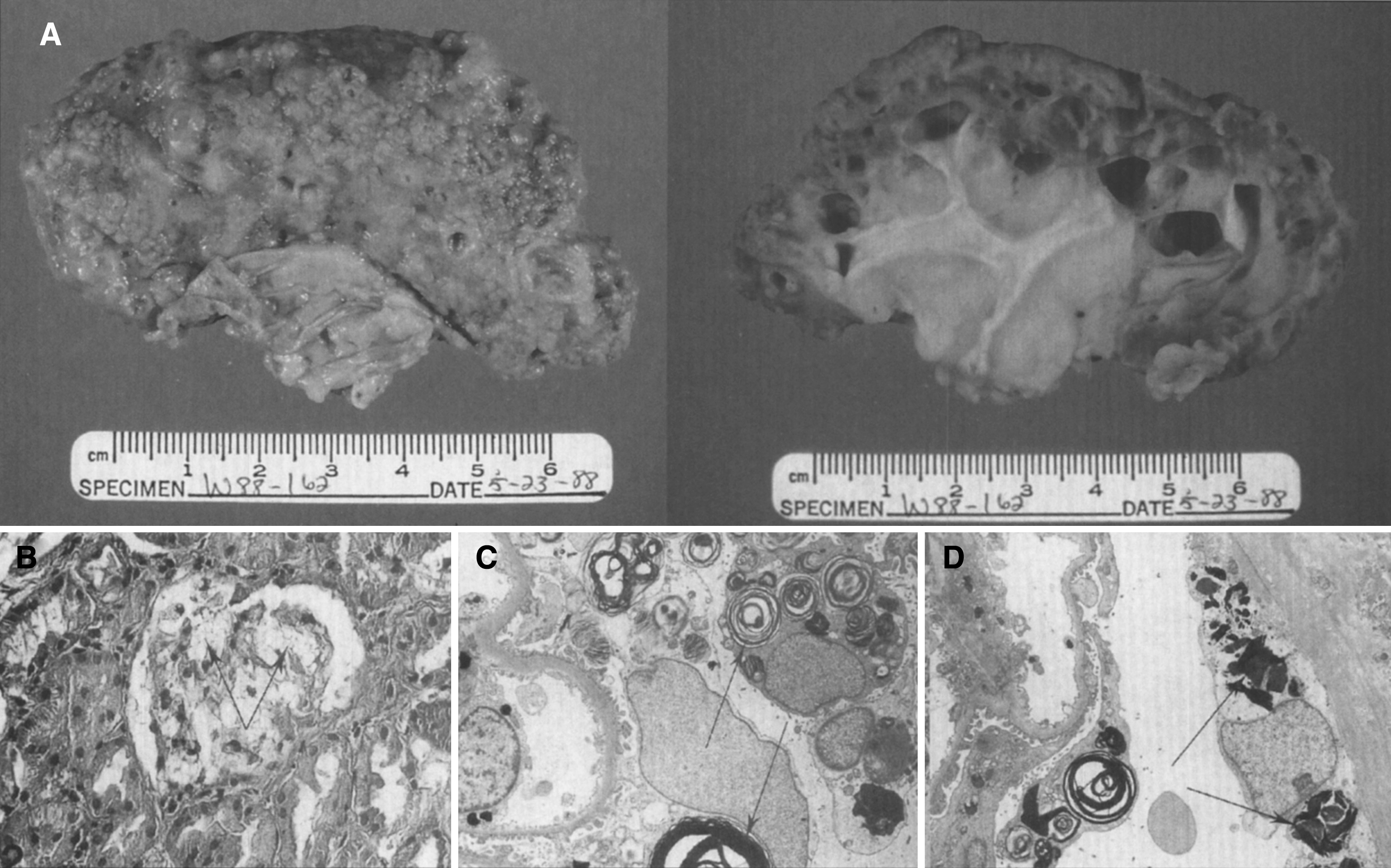 Fabry disease: kidney. (A) Gross appearance of end-stage disease with scarring and cyst formation. External view (left), cut surface (right). (B) Microscopic section of kidney glomerulus. Foamy glomerular epithelial cells are present. (C) Electron micrograph of kidney. Glomerular epithelial cells contain myelin-like figures. (D) Glomerular parietal epithelial cells show pleomorphic lipid inclusions.