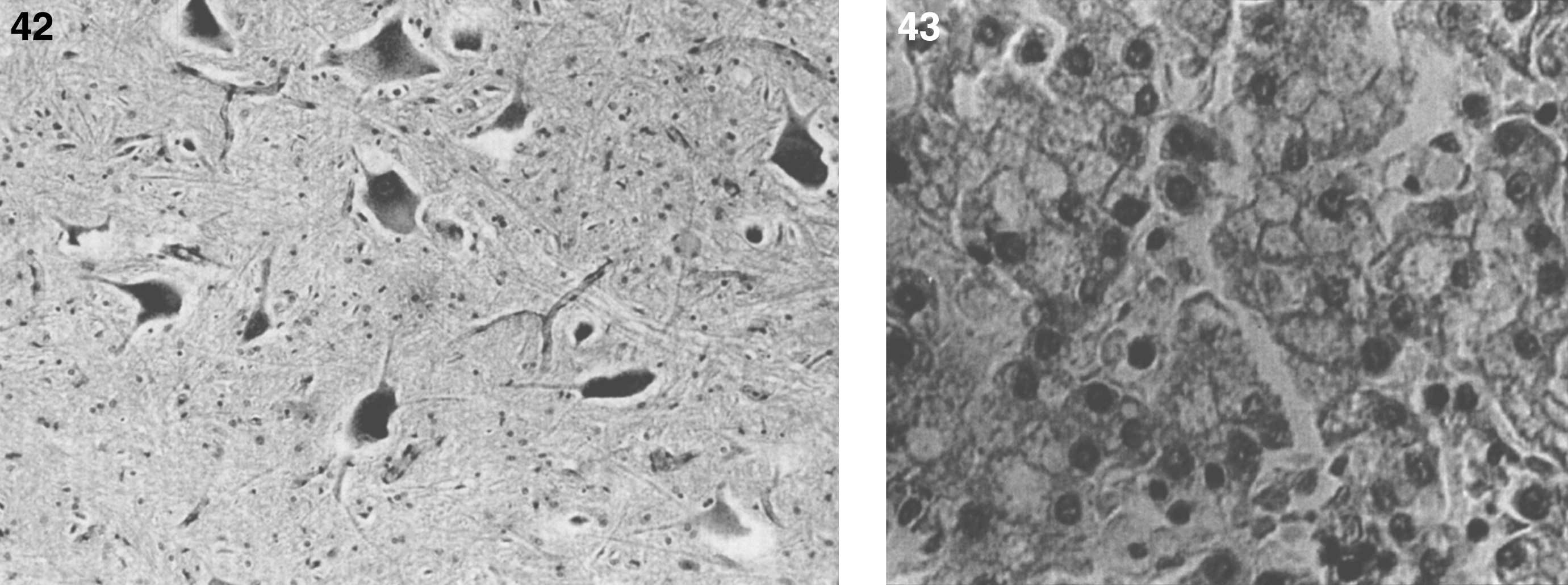 GM1 gangliosidosis type I: brain. The cortical neurons are distended with ganglioside; (43) GM1 gangliosidosis type I: liver. Some hepatocytes are swollen and contain storage material.