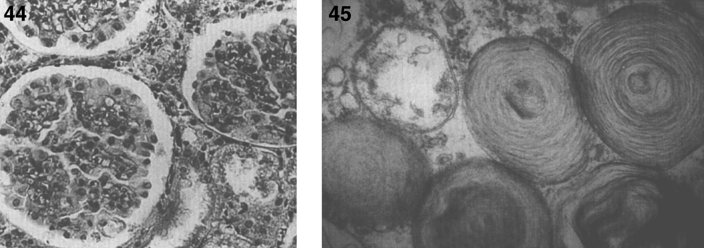 GM1 gangliosidosis type I: kidney. The glomerular epithelial cells are vacuolated; (45) GM1 gangliosidosis type I. Electron micrograph in conjunctival biopsy showing typical membranous concentric bodies (MCBs) of gangliosides. MCBs are the morphologic expression of gangliosides seen in all the gangliosidoses including Tay-Sachs disease.