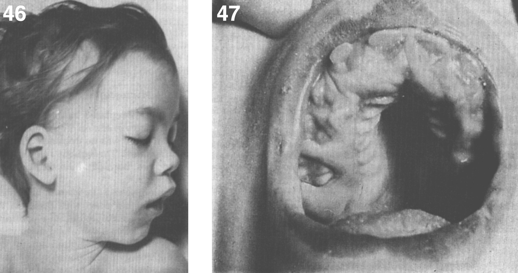 GM1 gangliosidosis type II. Facial appearance at autopsy. Mild anomalies of the ear and a prominent philtrum are present; (47) GM1 gangliosidosis type II. Appearance of oral cavity at autopsy. Note marked gingival hypertrophy.