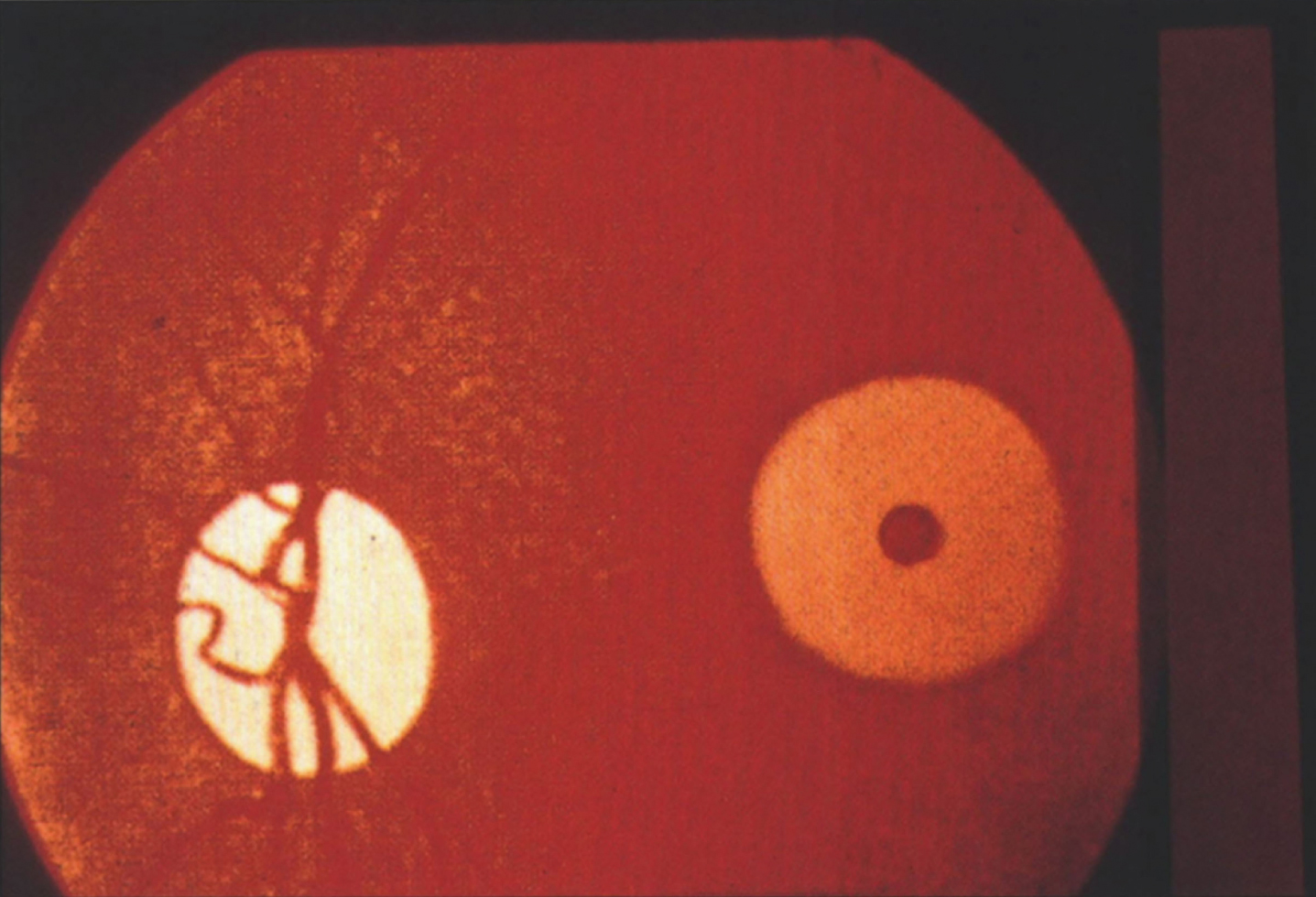 GM2 gangliosidosis type I (Tay-Sachs disease). The retina shows a cherry-red spot in the macula.