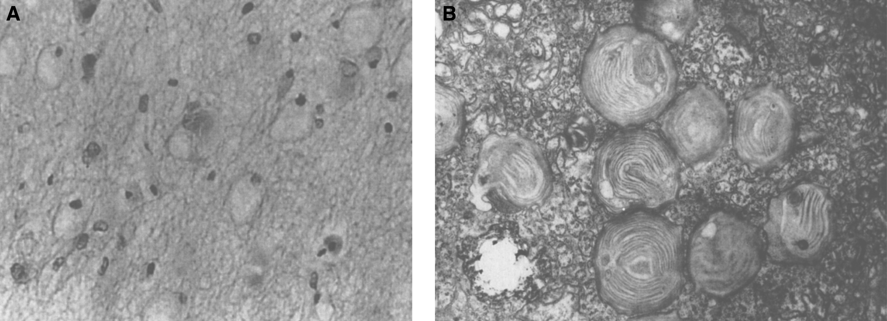 GM2 gangliosidosis type I (Tay-Sachs disease). (A) Microscopic section of the brain shows large swollen neurons due to accumulation of ganglioside. (B) Electron micrograph showing characteristic membranous concentric bodies.