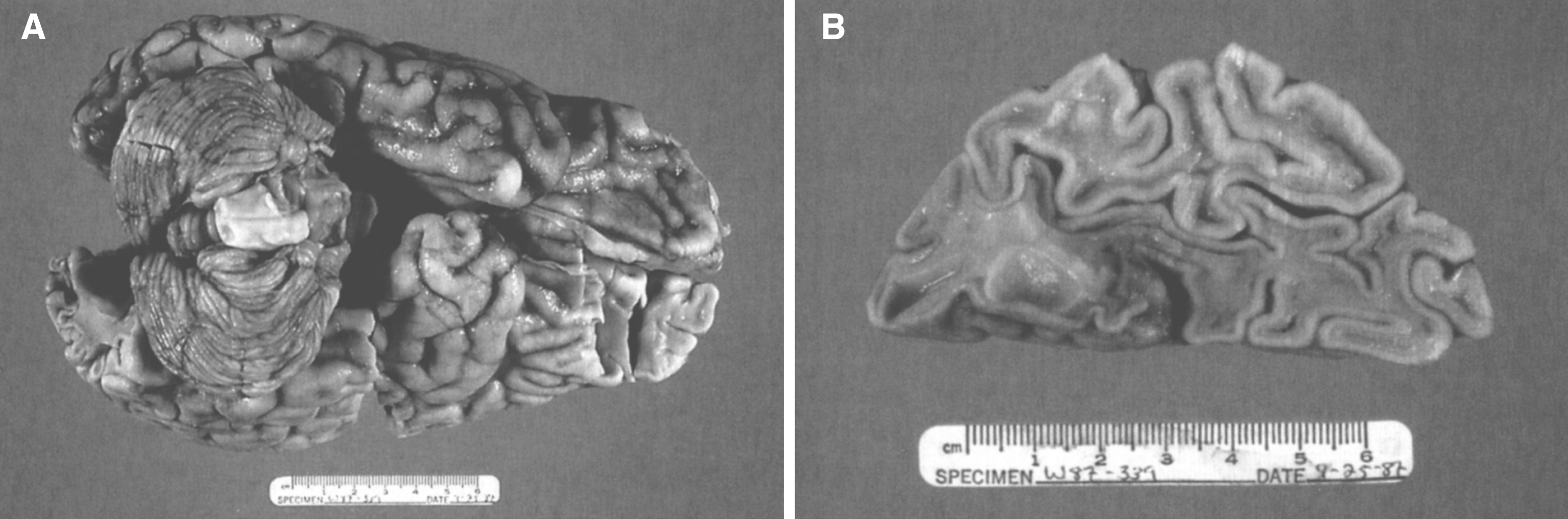 GM2 gangliosidosis type II (Sandhoff disease). (A) The brain shows atrophy of gyri. (B) On cross section, both gray and white matter are atrophic.