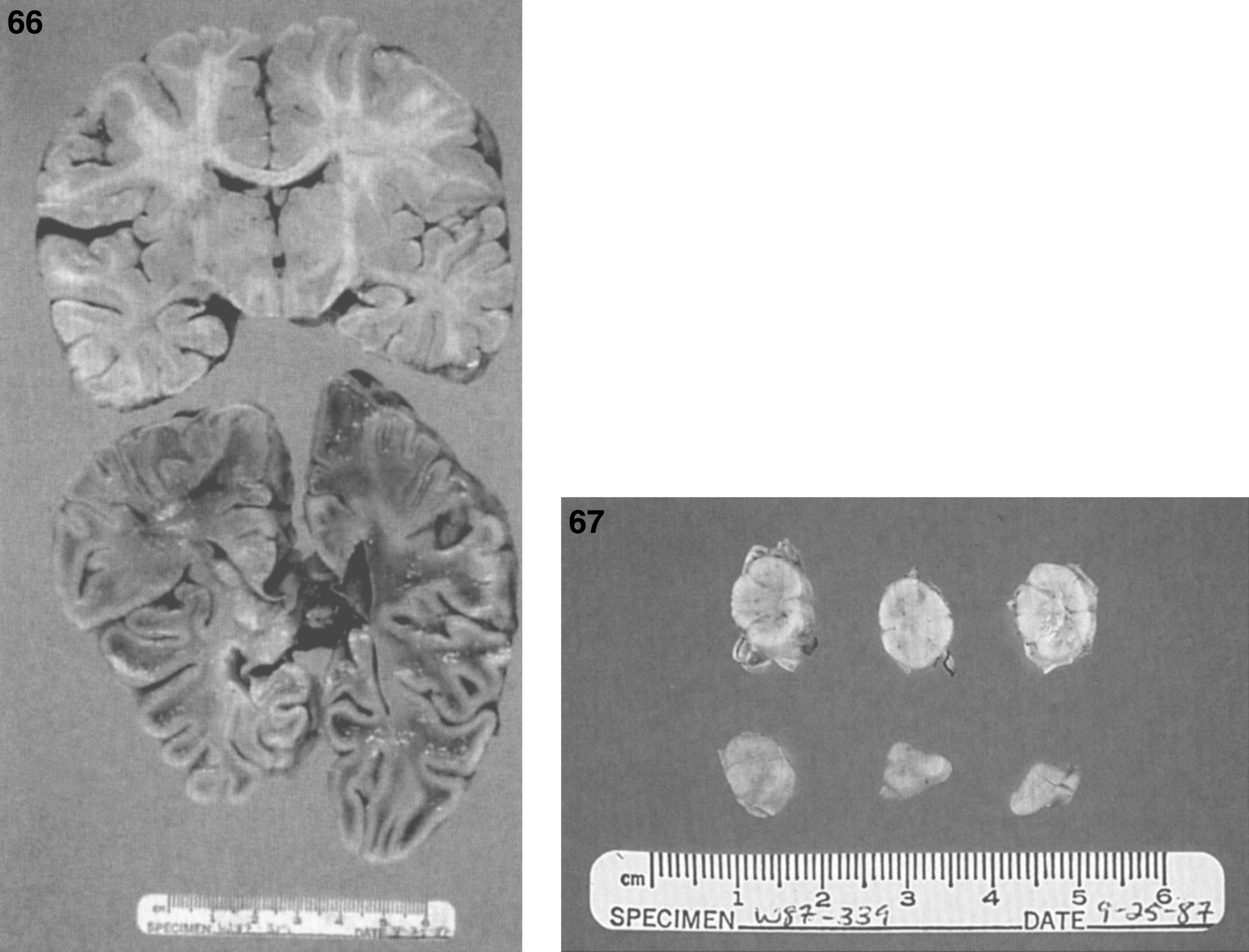 GM2 gangliosidosis type II (Sandhoff disease). A coronal section of the brain, normal brain (top) compared with severe cortical atrophy (bottom); (67) GM2 gangliosidosis type II (Sandhoff disease). A normal spinal cord (top) is compared with atrophy in Sandhoff disease (bottom).