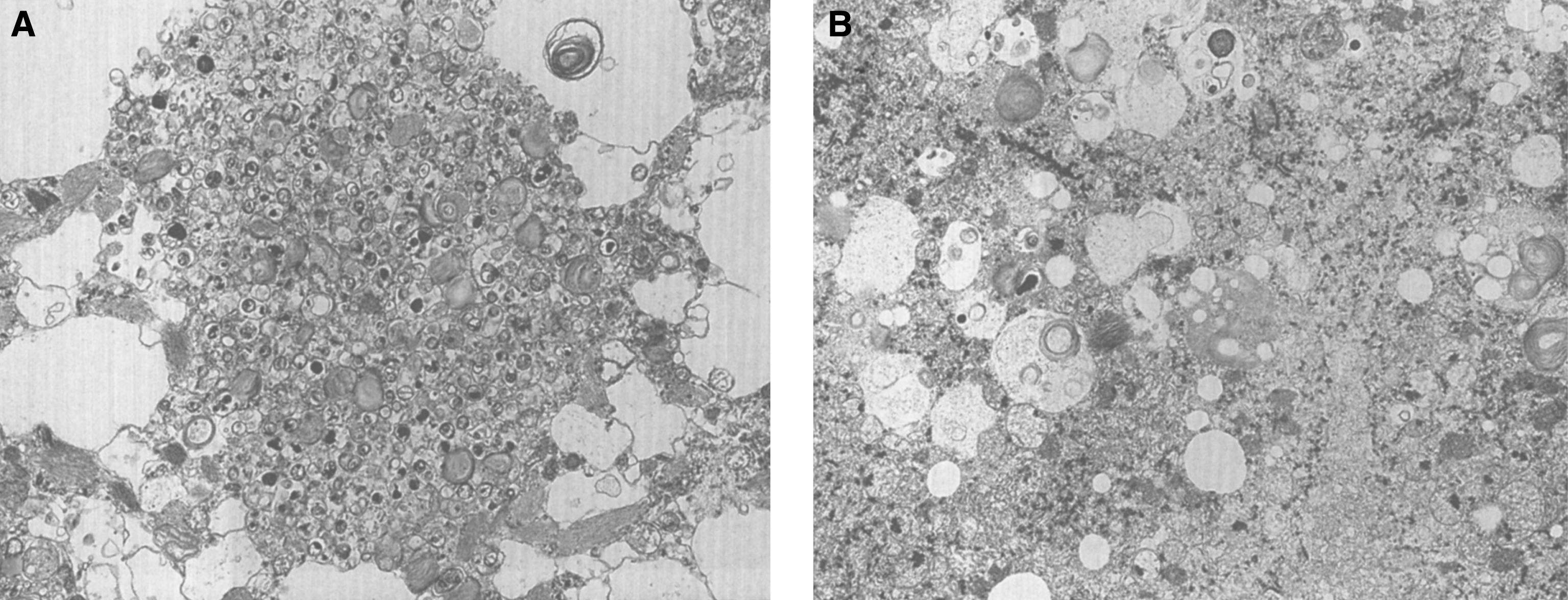 GM2 gangliosidosis type II (Sandhoff disease). Electron micrograph of (A) cerebral cortex showing inclusions of electron-dense profiles with concentric laminations, and (B) liver containing intracellular concentric laminations within hepatocytes.