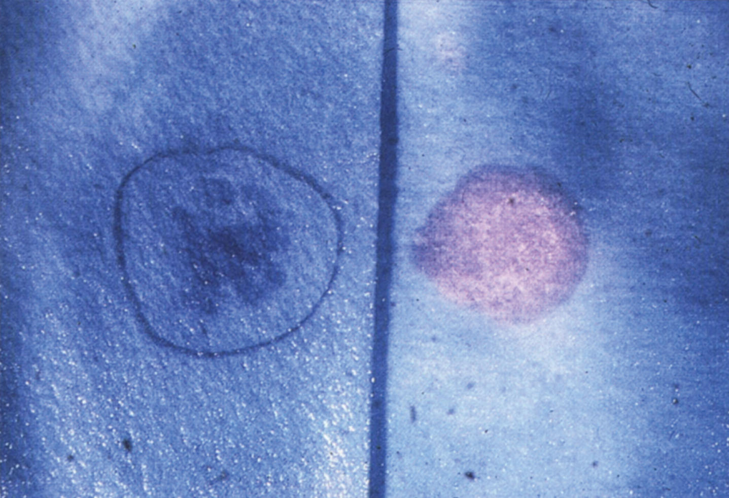 Metachromatic leukodystrophy. Urinary spot test showing metachromasia due to the presence of sulfatide (right) compared to normal (left).