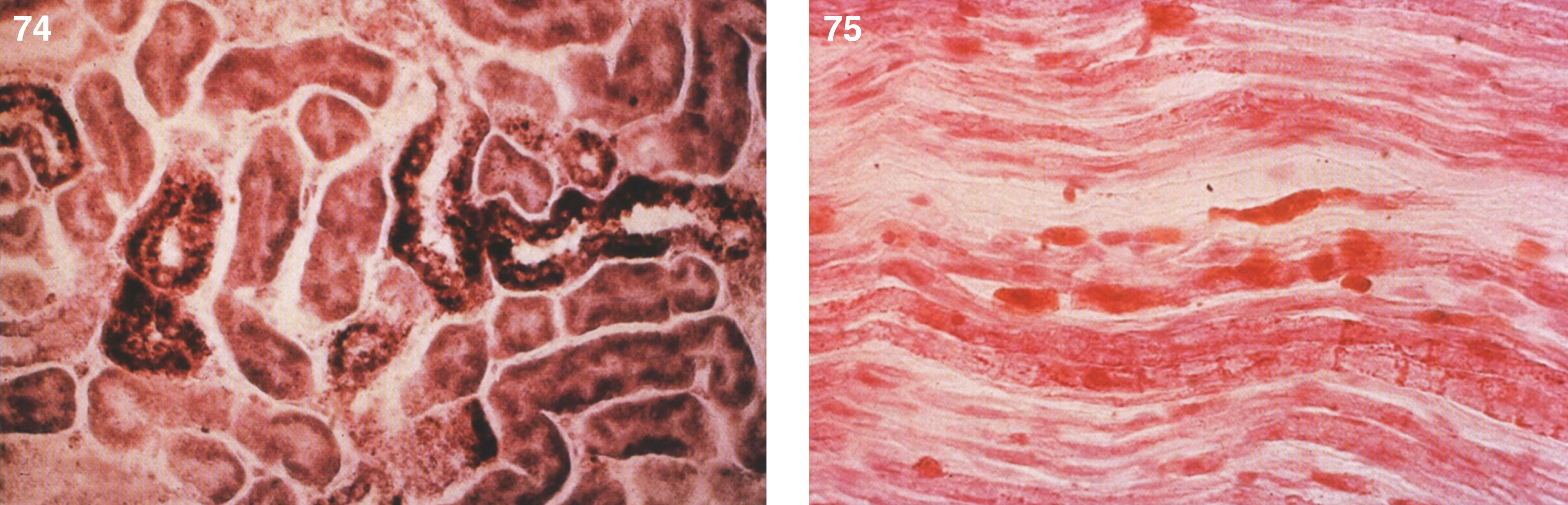 Metachromatic leukodystrophy. Microscopic section of the kidney shows brown metochromasia of the renal tubular epithelial cells; (75) Metachromatic leukodystrophy. A sural nerve biopsy show metachromatic substance within the nerve fibers.