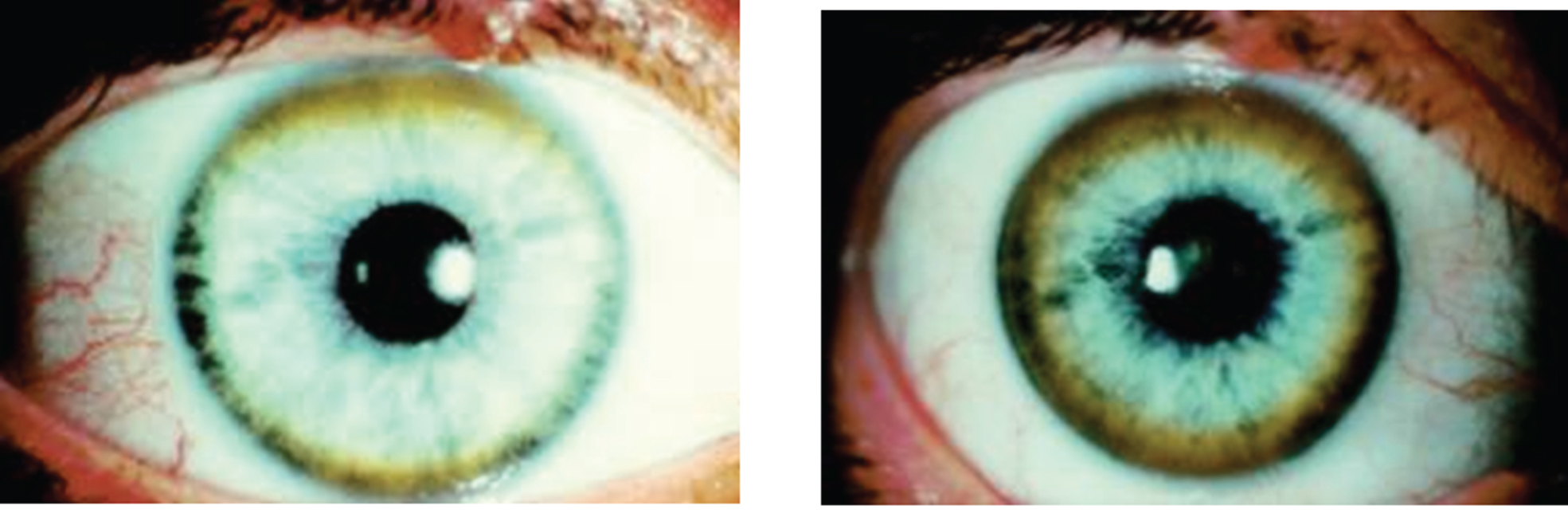 Appearance of Kayser-Fleischer ring in Wilson disease. Dark pigment at periphery of the cornea is due to deposition of copper.