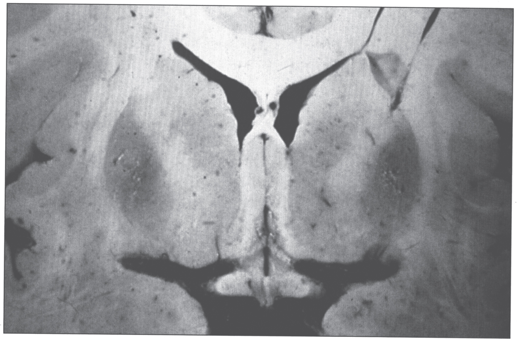 Wilson disease. Coronal section of brain showing small cystic cavitation and light brown discoloration in the basal ganglia, particularly in the putamen.
