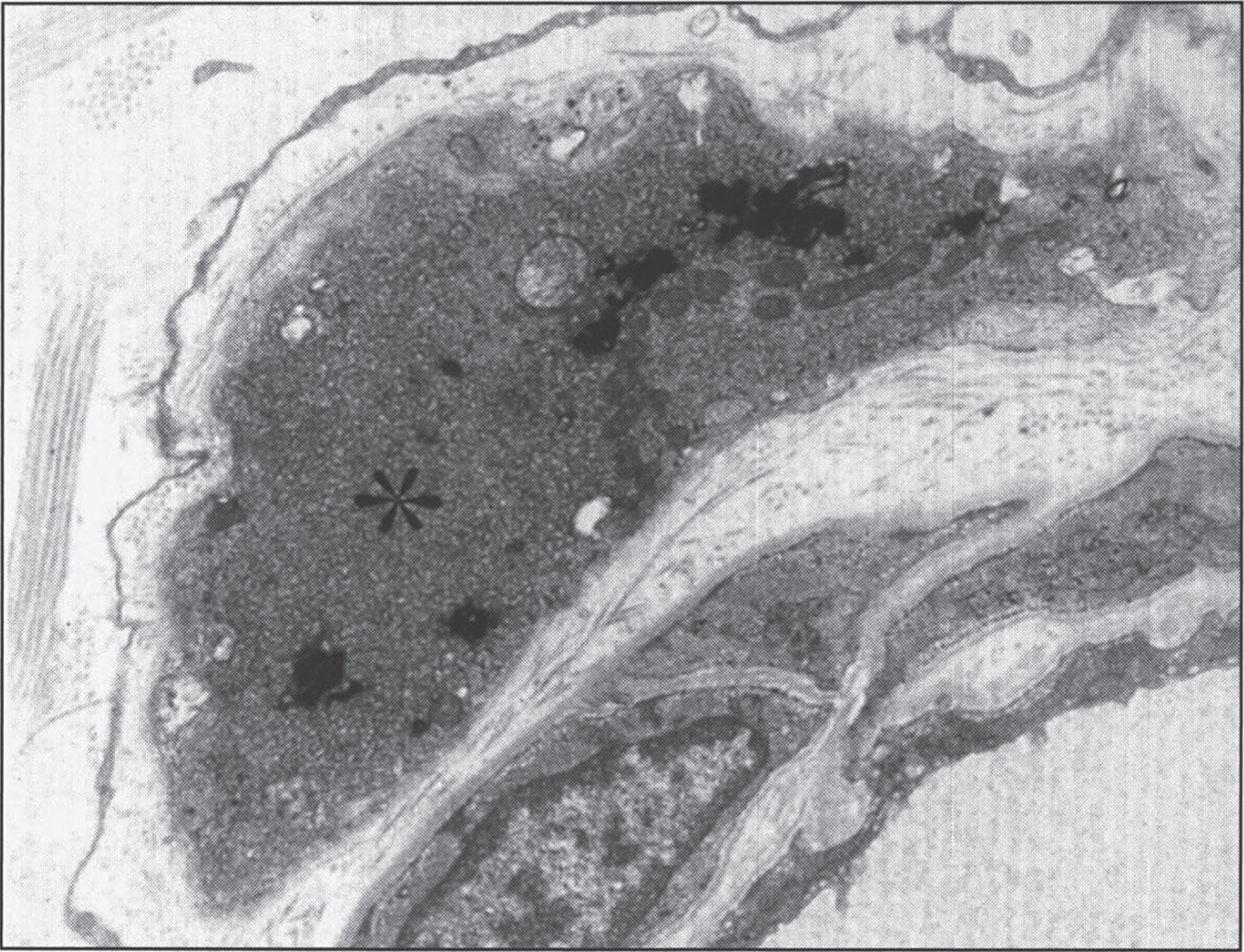 Infantile neuroaxonal dystrophy. A portion of one of the unmyelinated axons (asterisk) in this conjuctival perivascular nerve is distended by an accumulation of tubulo-membranous structures, degenerate organelles, and amorphous electron-dense materials. With these, distinctive axonal “spheroids” become more condensed and display characteristic clefts. (Courtesy of Dr. Gary Mireau.)