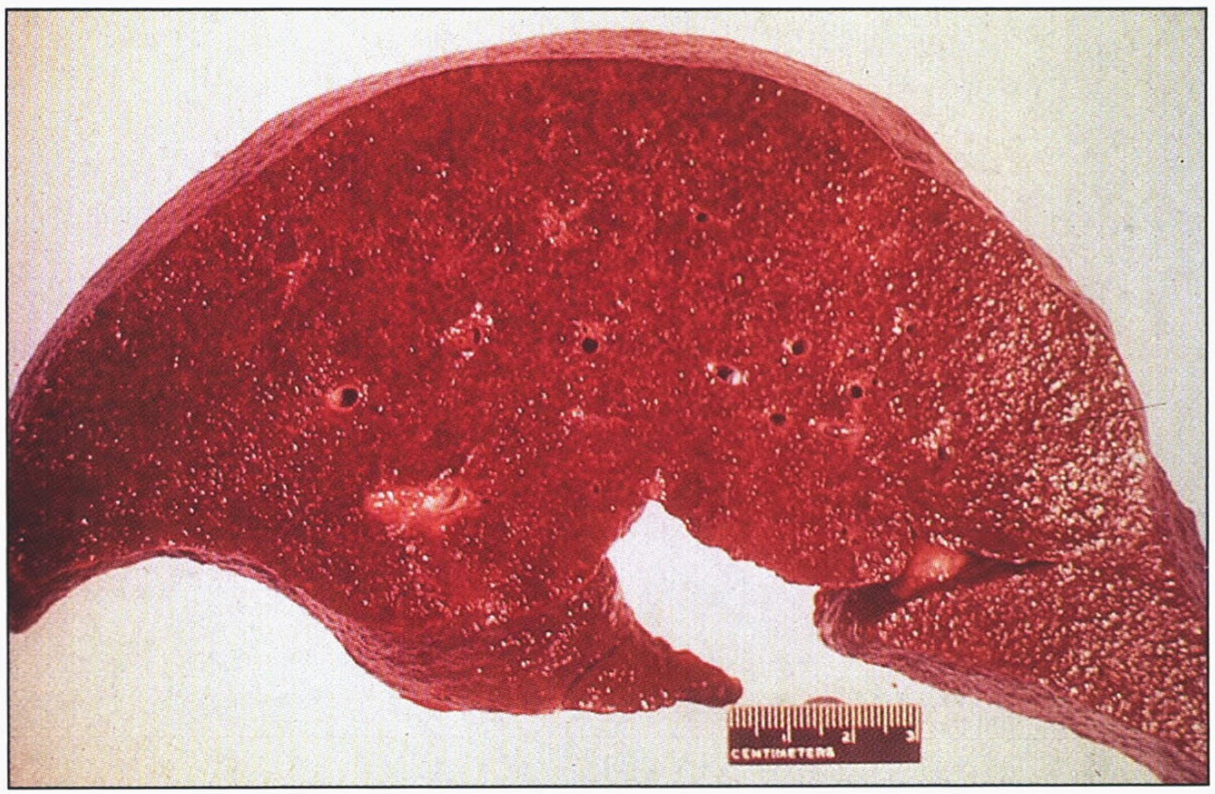 Hereditary hemochromatosis. Gross appearance of micronodular cirrhotic liver.