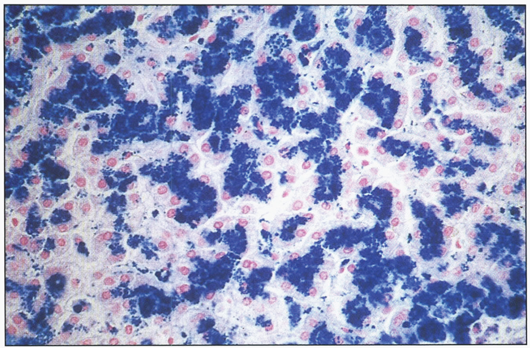 Microscopic appearance of liver in hereditary hemochromatosis showing iron in hepatocytes. Prussian blue stain.