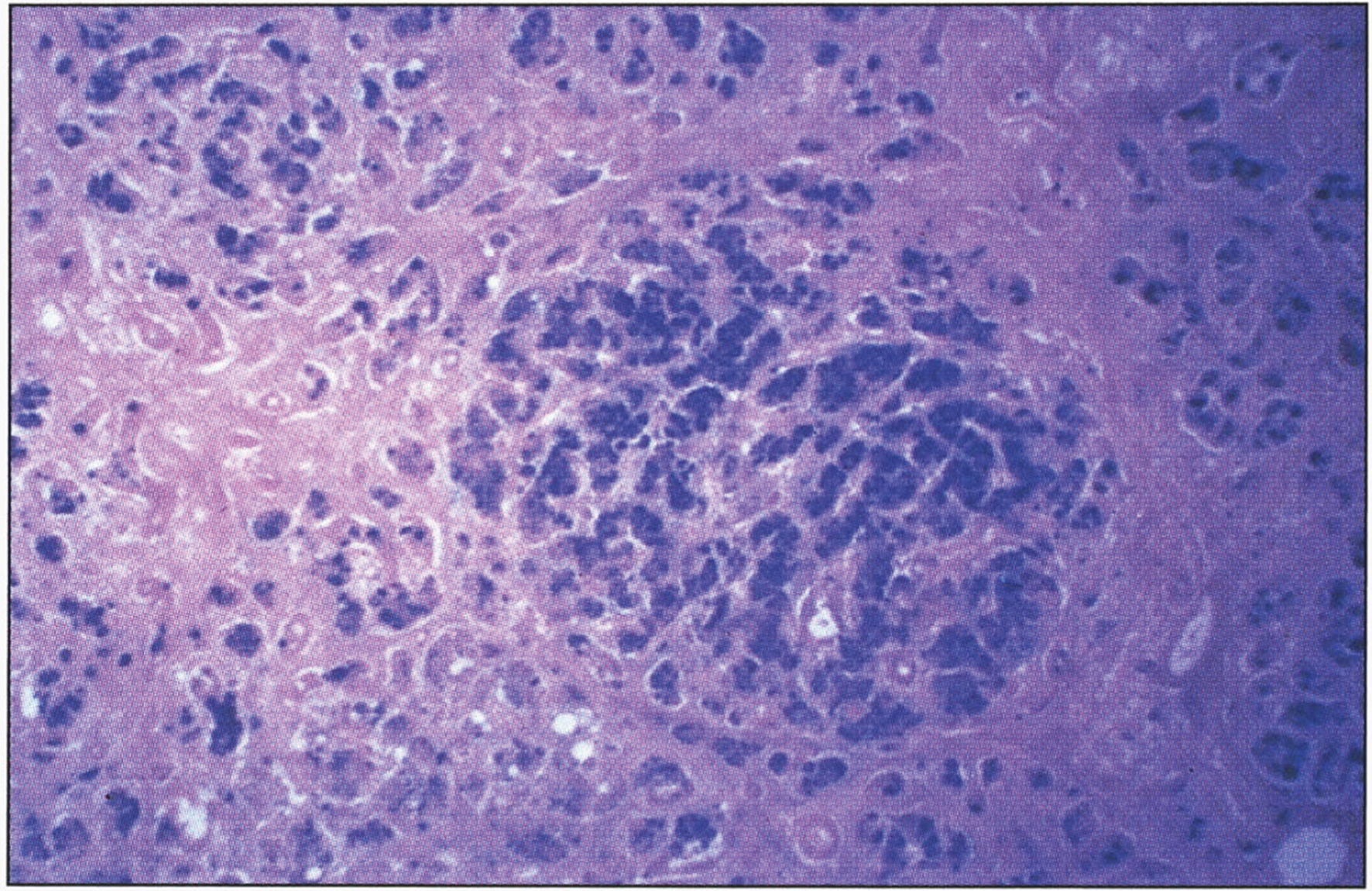 Microscopic appearance of the pancreas in hereditary hemochromatosis showing iron pigment in pancreatic acinar and islet cells. Prussian blue stain.