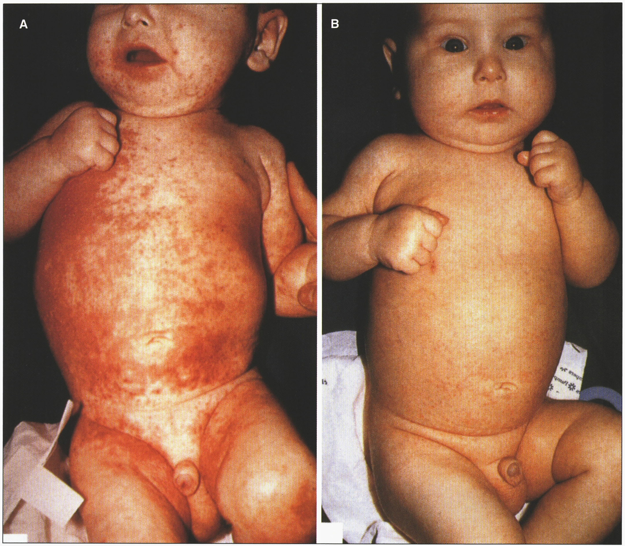 Acrodermatitis enteropathica showing skin rash. (A) Before treatment. (B) After zinc treatment. (Courtesy of Dr. Bernard Cohen.)